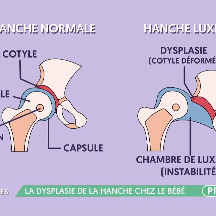 La Dysplasie De La Hanche Chez Le Bebe Extrait La Maison Des Maternelles En Streaming France Tv